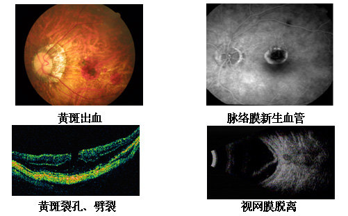 因玻璃体浑浊,出现飞蚊症   4,眼底病变:常见近视弧形斑,豹纹状眼底