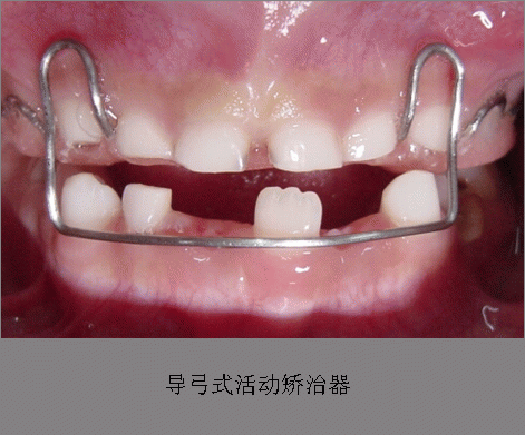 医生文章 详情 下面简要介绍一下几种常用的治疗"地包天"的矫正器