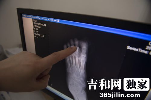 松原新娘婚礼前夜脚趾被钢管戳断 答谢宴成新郎独角戏