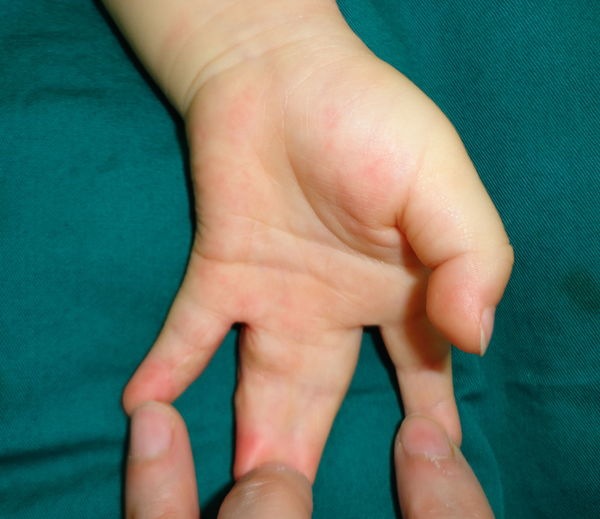 右手   现等待术后3个月图片,有兴趣的家长可以看看手术效果.