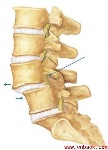在某些情况下,腰椎之间出现了"错位",即从侧面看x片,上面椎体在下面