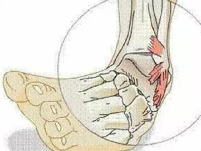 崴脚不用怕 告诉你热敷和冷敷怎么做