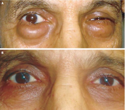 眼附属器粘膜相关性淋巴组织淋巴瘤