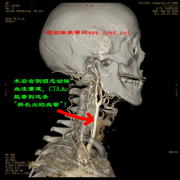 术后cta显示右侧颈总动脉血流重建,原来看不到血管的地方,显现出