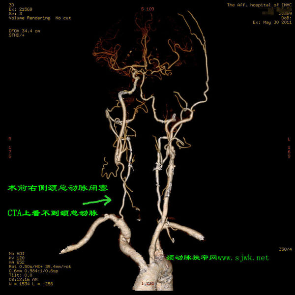 颈动脉闭塞,手术成功再通(附图)