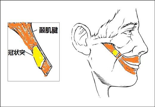 面瘫手术治疗专题七:微创颞肌-肌腱顺行转移术