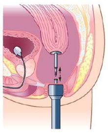 吻合器吻合肠管示意图