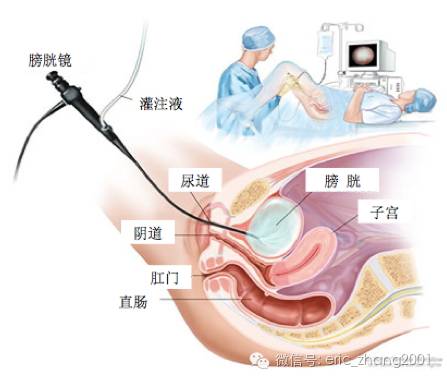 尿道梗阻,或任何膀胱及其粘膜表面异常,是泌尿外科医生最常用的检查