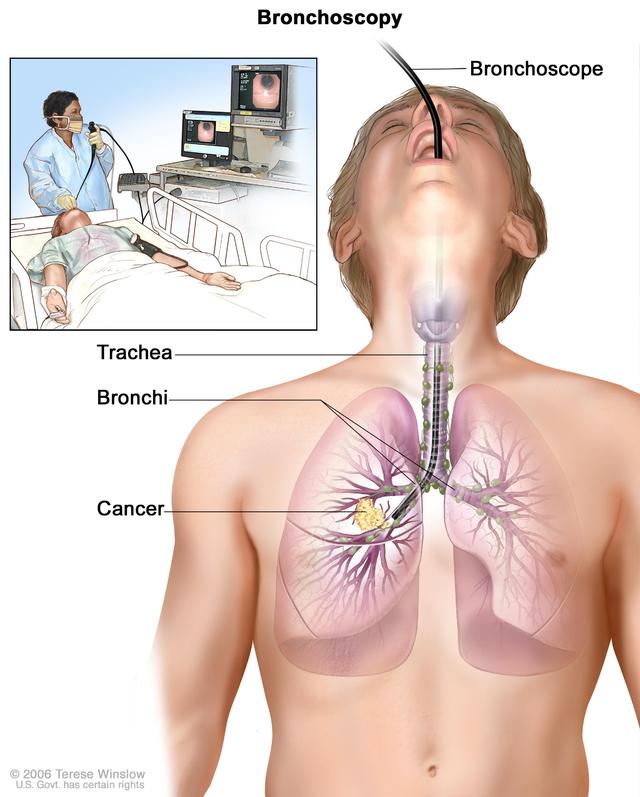 NSCLC 4.jpg