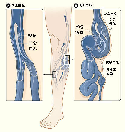 简单的说一下"静脉曲张"(下肢肿/沉/色斑/皮炎)