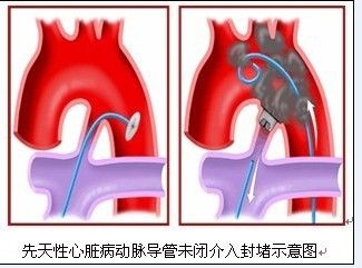 先天性心脏病介入微创手术