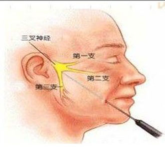 射频热凝技术