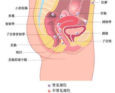 子宫内膜异位症的诊治与预防