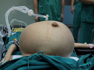 女孩腹部藏20公斤肿瘤 良性卵巢肿瘤的病因及并发症