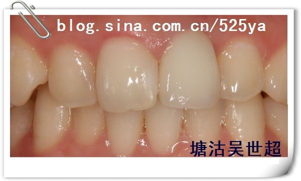 如何选择烤瓷牙、材料、价格_吴世超