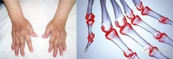 最多见的畸形有近端指间关节梭形肿大,爪形手,手指