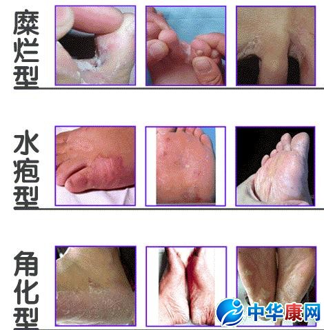 足癣,俗称脚气,是一种极常见的真菌感染性皮肤病.