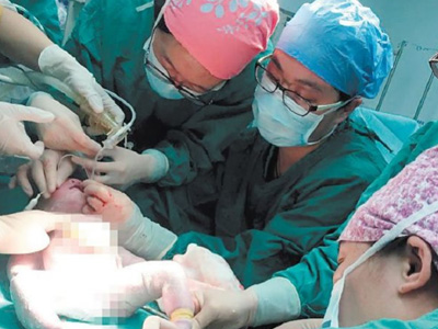 宝宝先天内脏膨出 专家特别设计“产时”手术