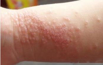 jpg 湿疹.jpg