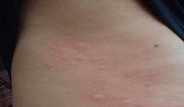 荨麻疹.jpg