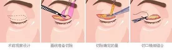 上睑下垂矫正手术   1,手术创伤:与传统矫正手术相比,创伤小,无