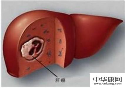 肝癌细胞在环境中能活多长时间呢