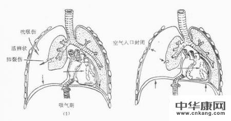 至于复发的问题,如果不再遭受到比较大的撞击力,胸廓不再遭受到开放性