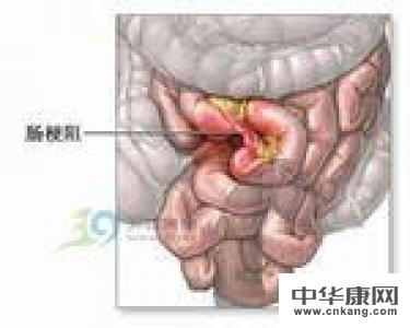 有腹腔术史的肠梗阻患者痛过什么方法治愈