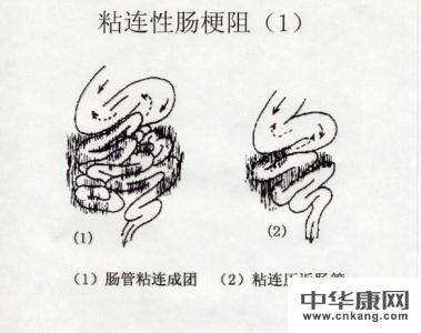 有腹腔术史的肠梗阻患者痛过什么方法治愈