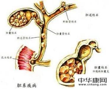 外科 胆结石 治愈率          男女发病之比约为1:2,由于女性胆囊结石