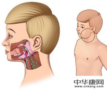 腮腺炎引起的睾丸炎导致无精的能否治愈