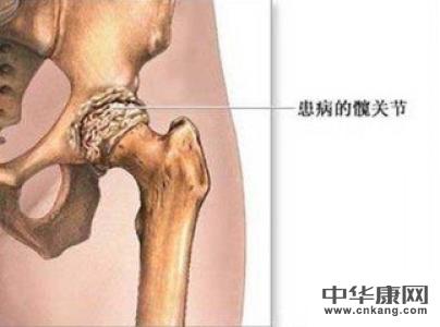 股骨头坏死症状有哪些