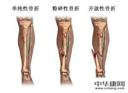骨折后遗症以及护理要点
