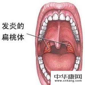 扁桃体发炎,感冒发烧有什么药可以治疗?