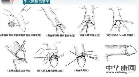 包茎对男性健康有哪些危害