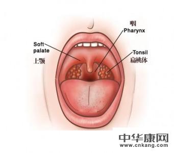 急性咽炎什么时候停药合适?