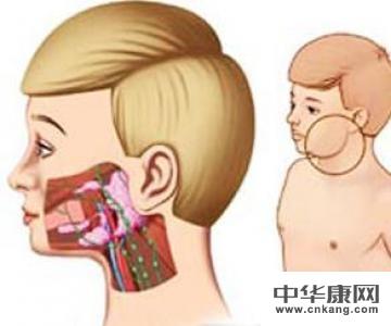 儿童复发性腮腺炎怎么治疗