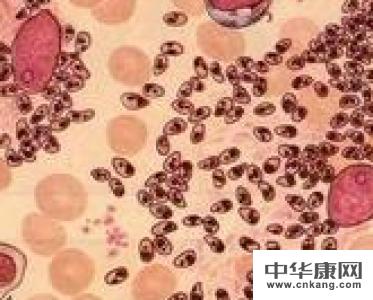 黑热病的治愈标准是什么