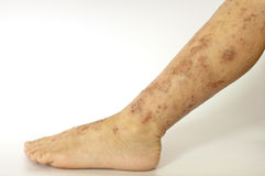 湿疹除了痒还有什么危害