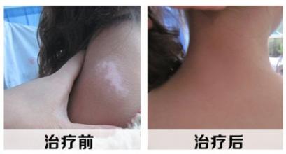 生活中男性患白癜风如何调理呢