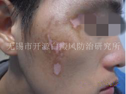 20岁男性面部、颈部患白斑一年半2.png