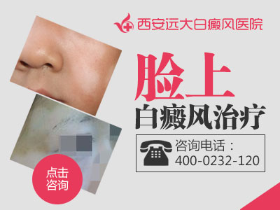 脸上白癜风治疗.jpg
