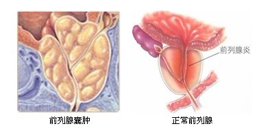 前列腺囊肿的误区是什么