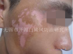 20岁男性面部、颈部患白斑一年半1.png