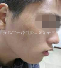 20岁男性面部、颈部患白斑一年半3.png