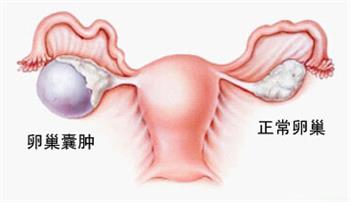 卵巢囊肿.jpg