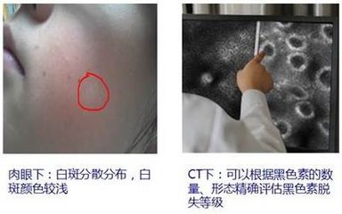t019c5708f4b026f338.jpg肉眼现白癜风那个成像.jpg