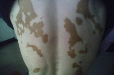 如何有效预防少年泛发型白癜风的扩散