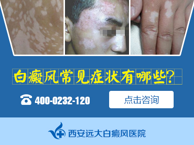 白癜风常见症状有哪些？-2.jpg