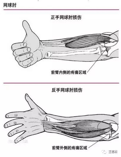 远离"网球肘"?炸糕与滑翔机图片
